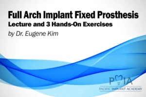 Full Arch Implant Fixed Prosthesis